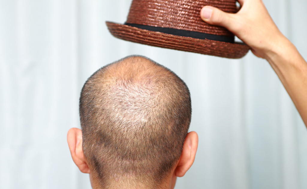 WHAT CAUSES HAIR LOSS? CAN PRP TREATMENT HELP?