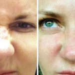 Bunny Lines Treatment | Remove Nose Wrinkles with Botox® - Beautiphi