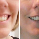 Gummy Smile with Botox | Hide Upper Gums & Get Beautiful Smile