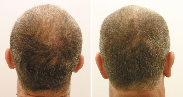 PRP Hair Loss Treatment - Procedure, Complication, Saftey