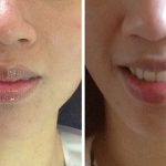 Botox for Jaw Reduction | Facial Slimming - Beautiphi