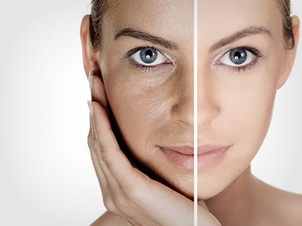 skin rejuvenation Dermaplaning before & after