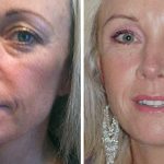 Botox Facial Treatment