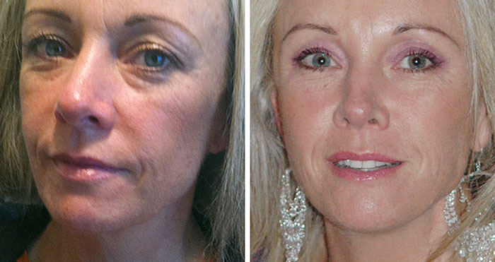 Botox Facial Treatment