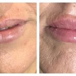 lip fillers before and after - Beautiphi auckland