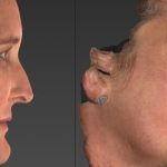 Nose filler before & after-beautiphi-auckland