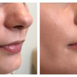lip fillers before and after - Beautiphi auckland