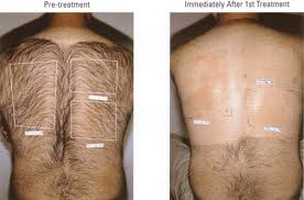 IPL Hair Removal - Before And After