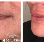 lip fillers before and after - Beautiphi auckland