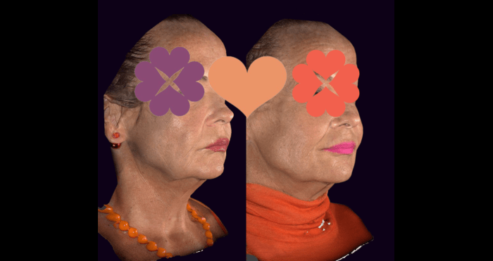 dermal filler treatments for sagging cheeks - Before & After