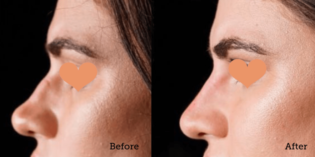 Non-Surgical Nose Job